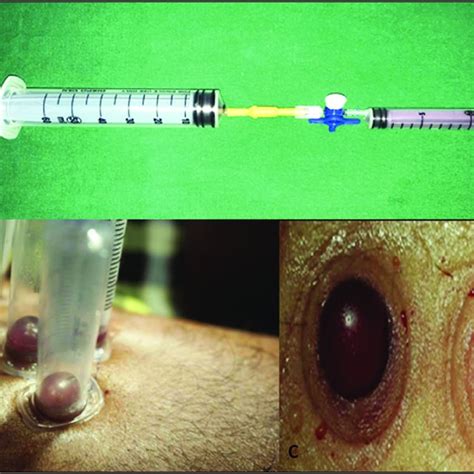 mavc login register|Performing Suction Blister Skin Biopsies .